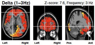 Delta wave brain scan before neurofeedback therapy